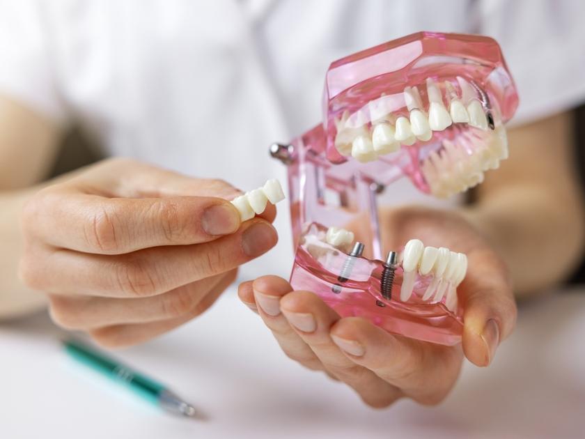 best-clinic-for-dental-bridges-in-yarraville-australia