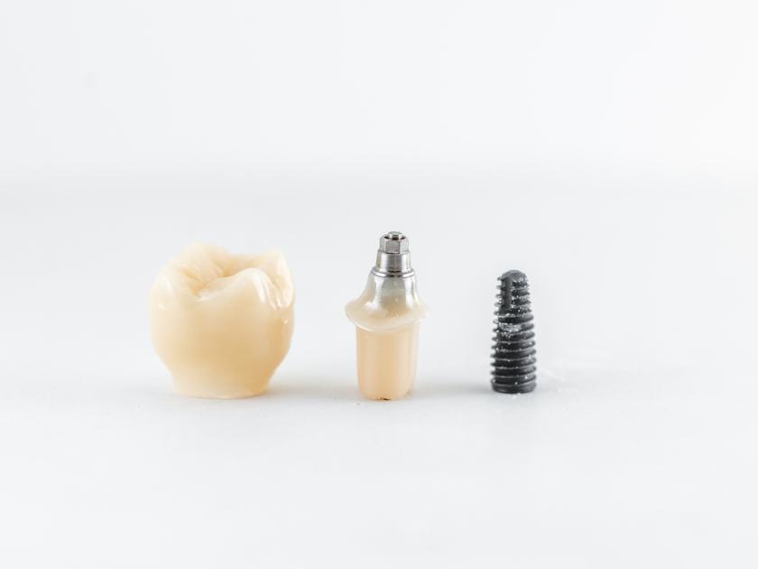 best-clinic-for-dental-crowns-in-yarraville-australia