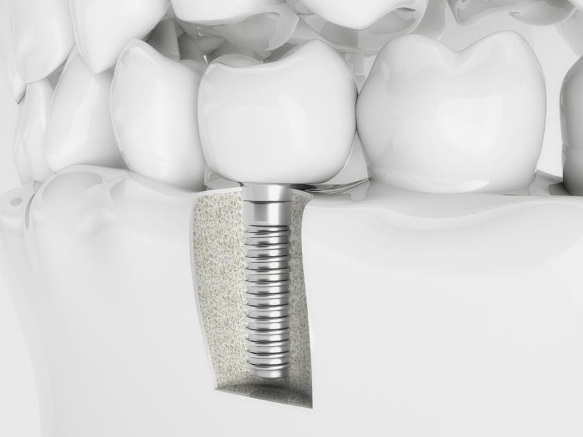 best-clinic-for-implant-restoration-in-yarraville-australia