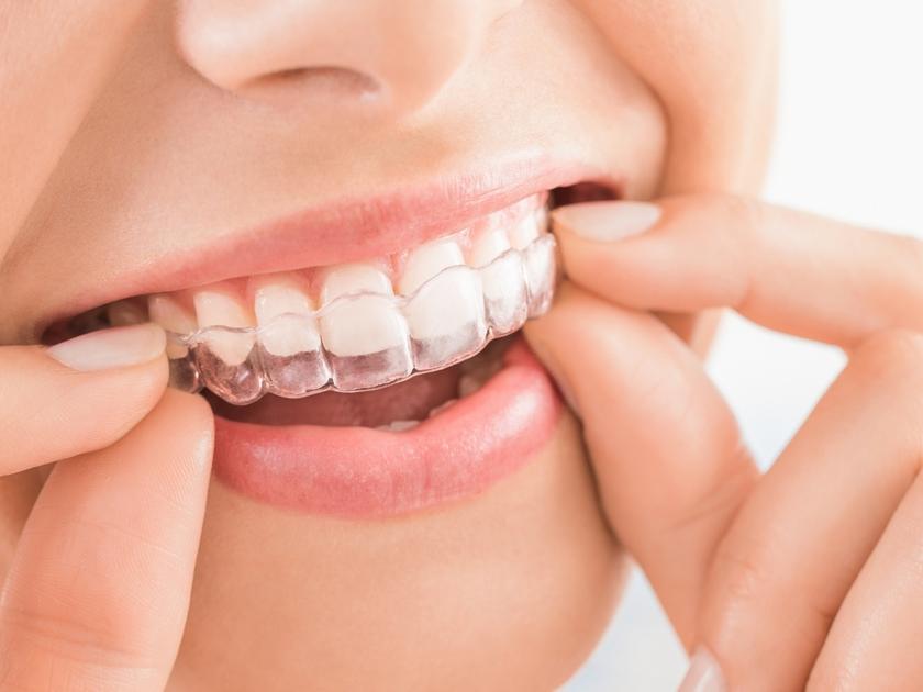 best-clinic-for-invisalign-braces-aligners-in-yarraville-australia
