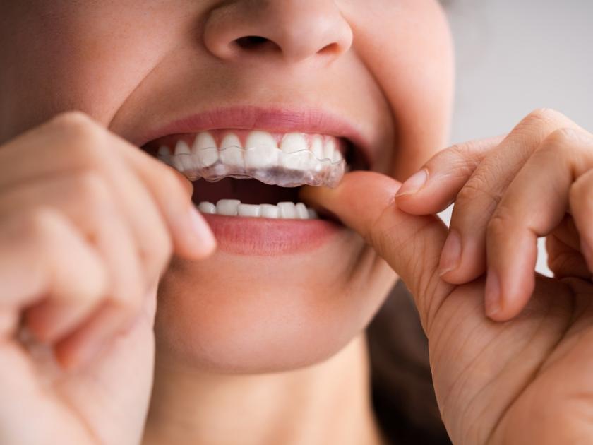 best-clinic-for-mouth-guards-night-guards-treatment-in-yarraville-australia